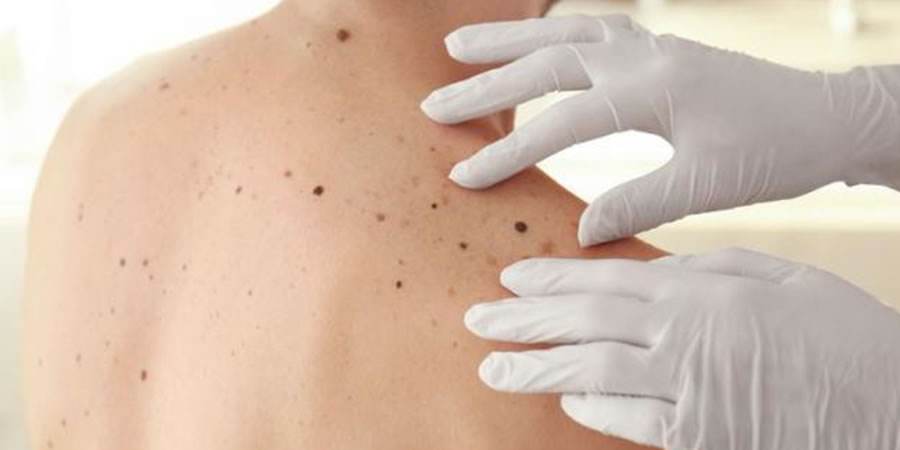LLAMA LA FUNDACIÓN MEXICANA PARA LA DERMATOLOGÍA A PREVENIR CÁNCER DE PIEL CON HÁBITOS DE AUTOEXPLORACIÓN Y FOTOPROTECCIÓN