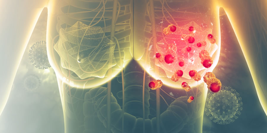 ES EL CÁNCER DE MAMA TRIPLE NEGATIVO METASTÁSICO UNA AGRESIVA VARIANTE
