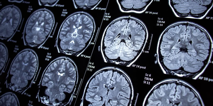 MAYO CLINIC EXPLORA SEÑALES CEREBRALES PARA DETENER CONVULSIONES ANTES DE QUE OCURRAN
