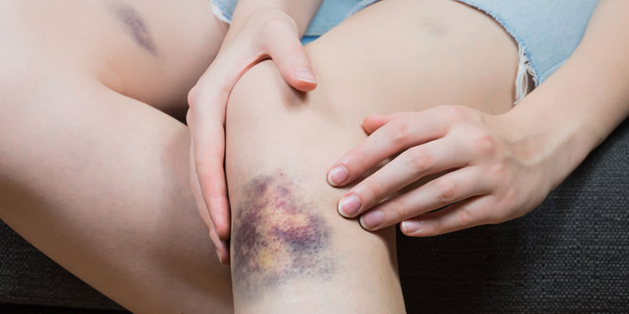 MORETONES SIN CAUSA APARENTE, SANGRADO DE ENCÍAS O HEMORRAGIAS NASALES FRECUENTES, PUEDEN SER SEÑALES DE LEUCEMIA